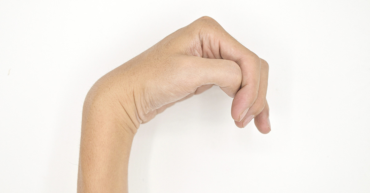 hand affected by hemiparesis, a condition characterized by muscle weakness on one side of the body