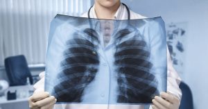 The Ability to Reverse Damage to Your Heart and Lungs is Closer Than You Think a doctor in a white coat examining a chest X-ray