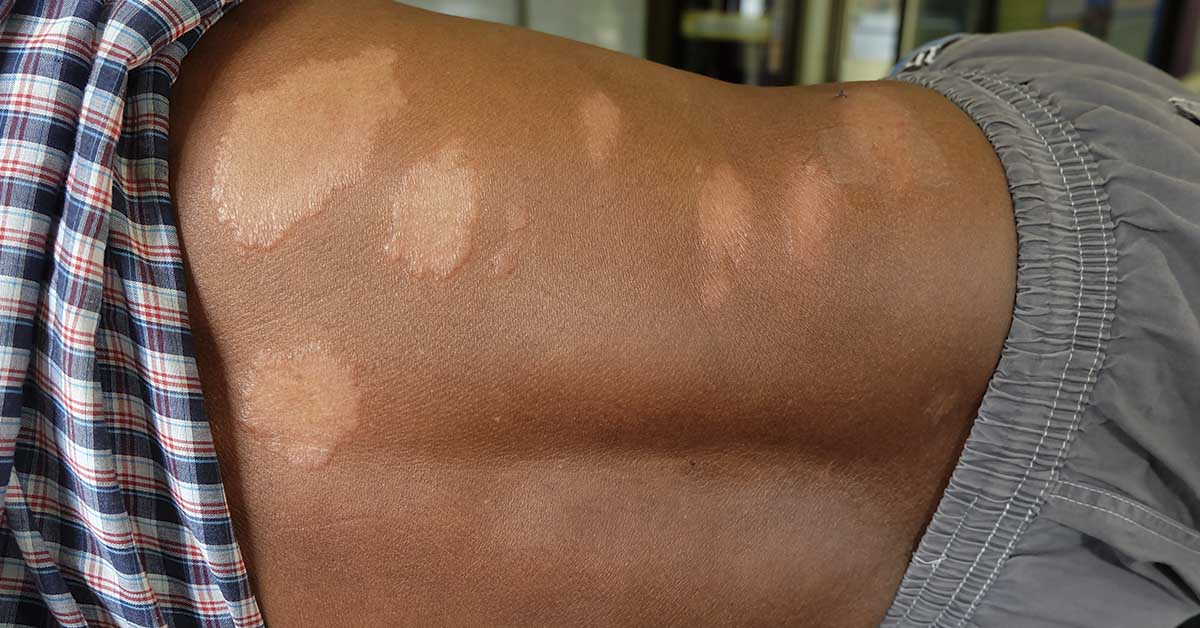 Leprosy, skin of the patient Leprosy , The white band on the back of the man