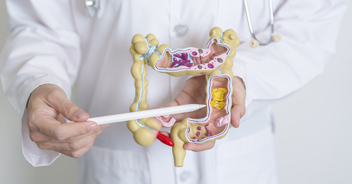 medical professional holding a model of the human colon. This model is often used for educational purposes to show the different parts of the colon and to explain various diseases.