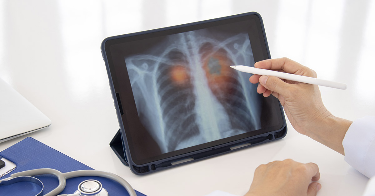 medical scan of the lungs, likely related to lung cancer