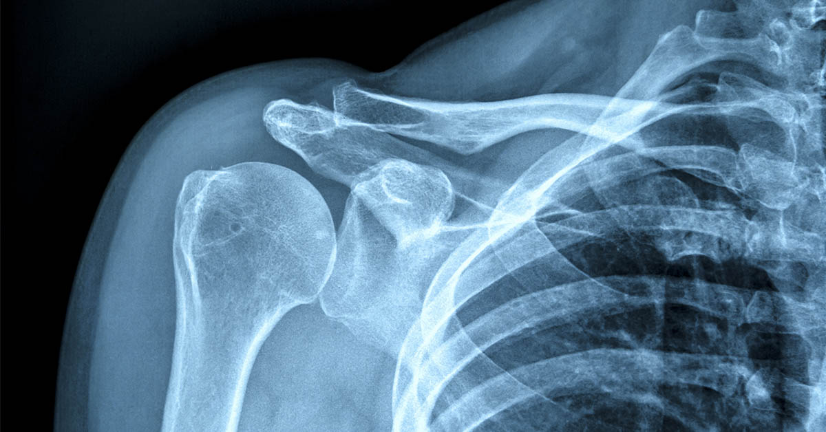 x-ray of shoulder area