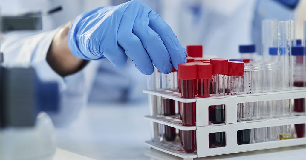 Johns Hopkins Blood Test Detects Tumor DNA Up to Three Years Early - Featured image