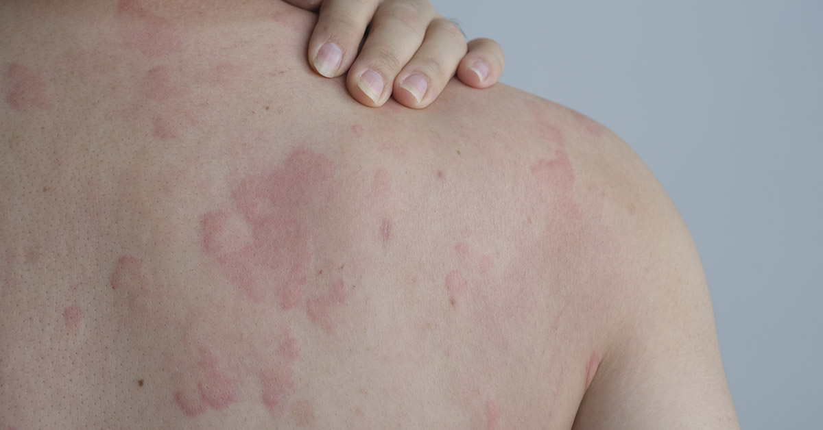 close up, woman with hand reaching over back of shoulder to scratch hives