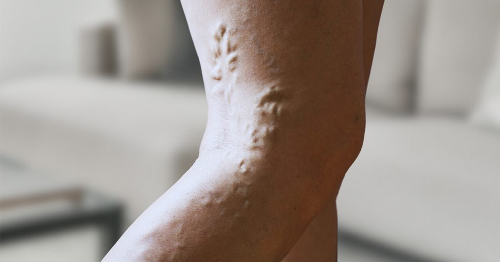 Hidden Triggers of Deep Vein Thrombosis You Should Know - Featured image