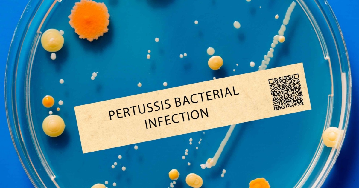 Pertussis (whooping cough) - Bacterial infection that causes severe coughing fits