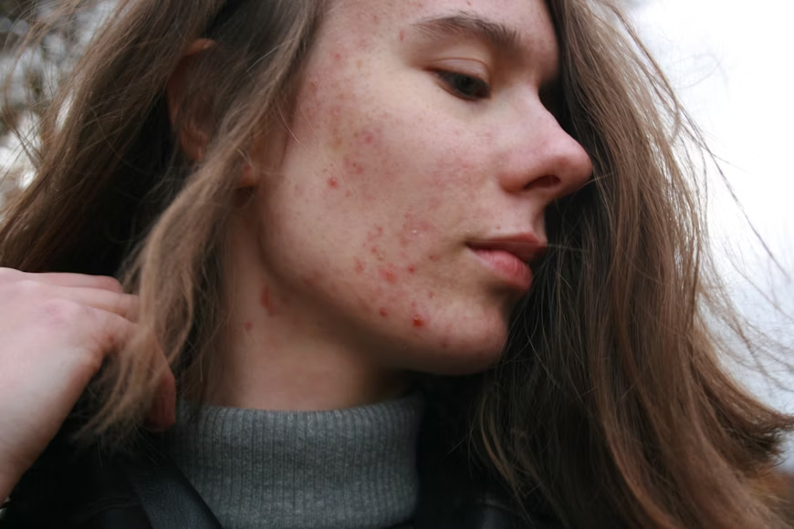 woman with bad skin and pimples