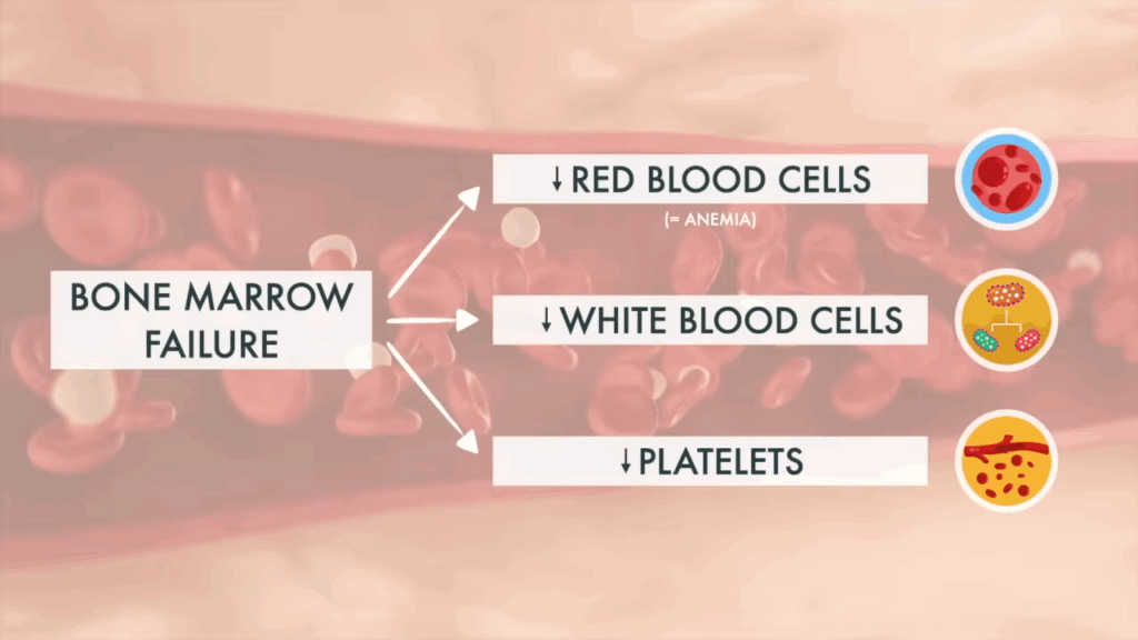 Diagram of bone marrow failure reducing blood cell production.