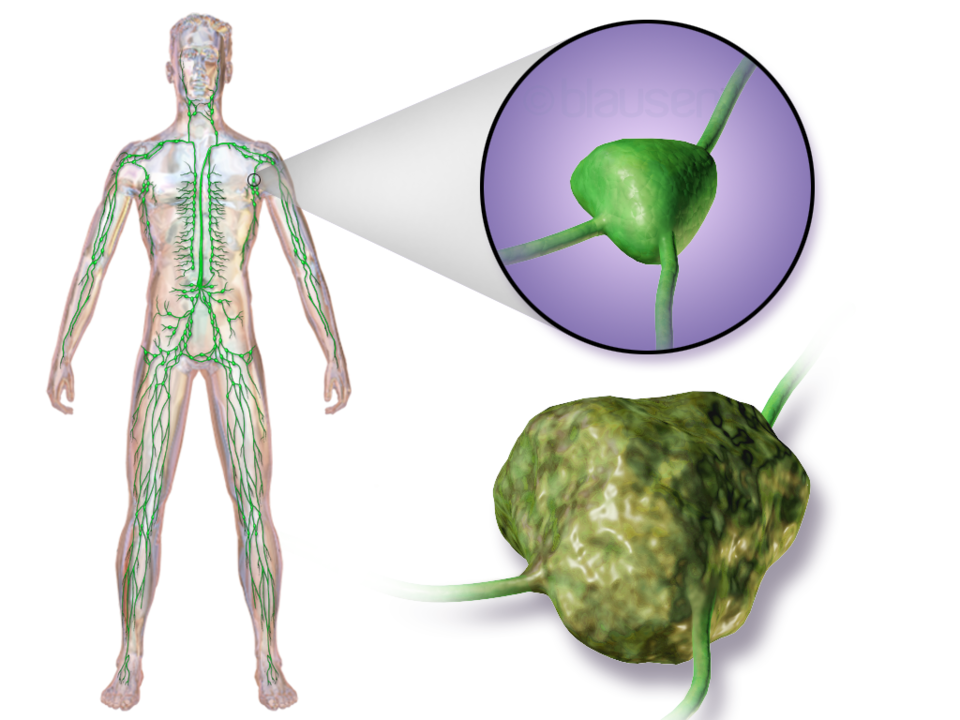 Anatomical illustration of human lymphatic system with magnified views of normal and swollen lymph nodes.