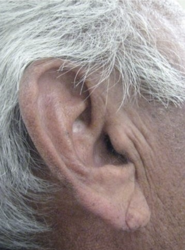 ear of an elderly