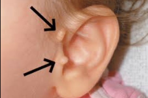 child's ear