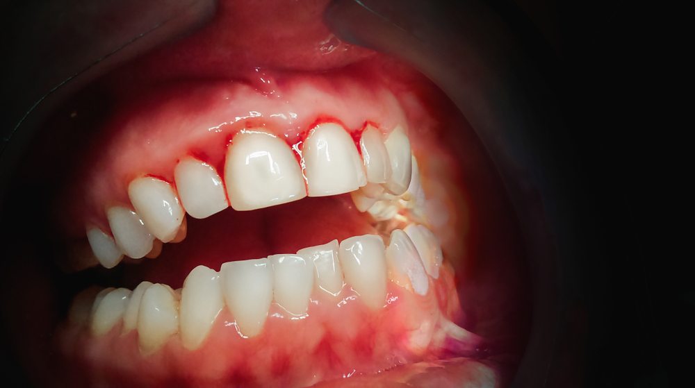 Mouth with bleeding gums on a dark background. Close up.