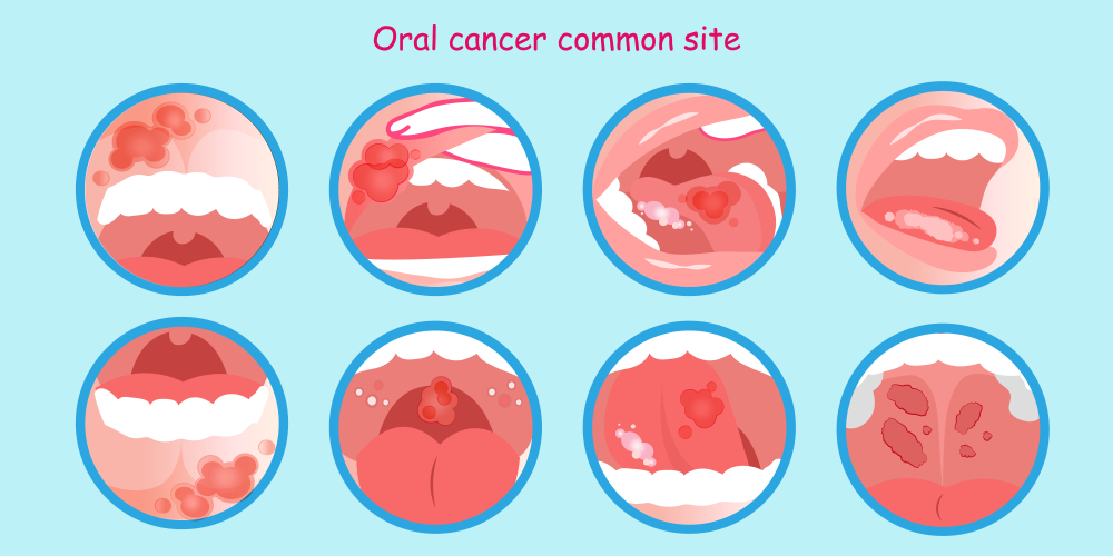 oral cancer commom site on the blue background