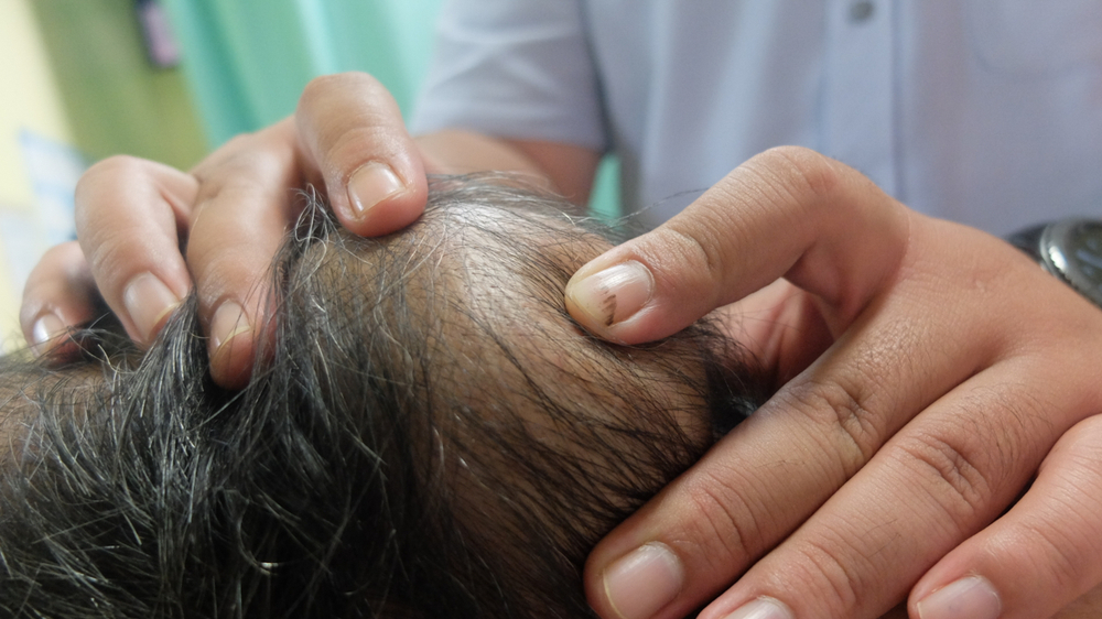 Huge Occipital Scalp Lipoma.