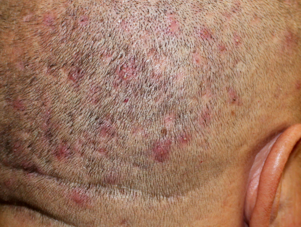A case of Malassezia-associated folliculitis in a male.