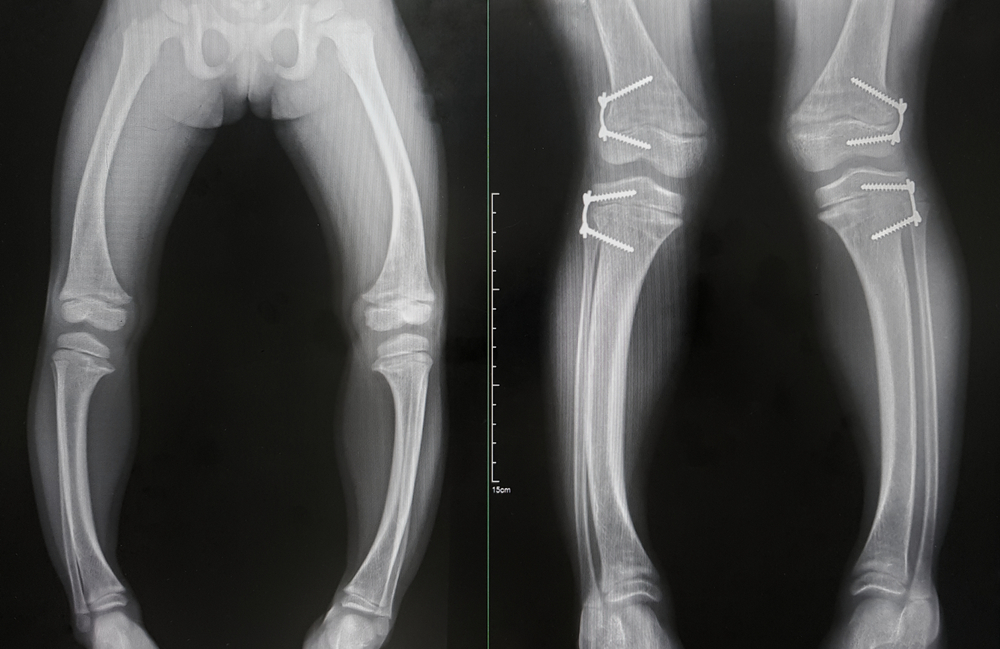 The x-ray of Rickets disease from hypophosphate is shown varus deformity and widening medial physis of bone. The other show improved alignment after the epiphysiodesis of both femurs and tibias.