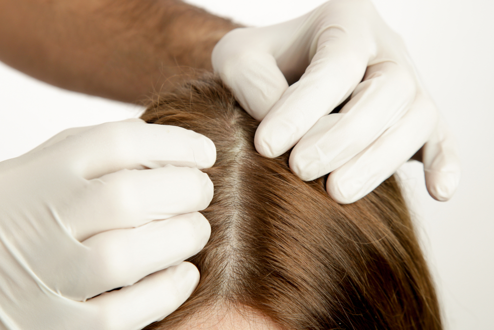 Doctor examining womans hair scalp, scalp eczema, dermatitis, psoriasis, hair loss, dandruff or dry scalp problem