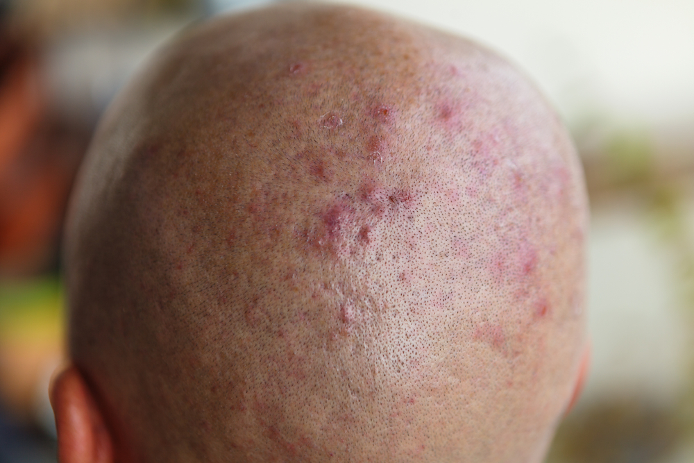 Man's shaved head with diseased skin, acne and eczema