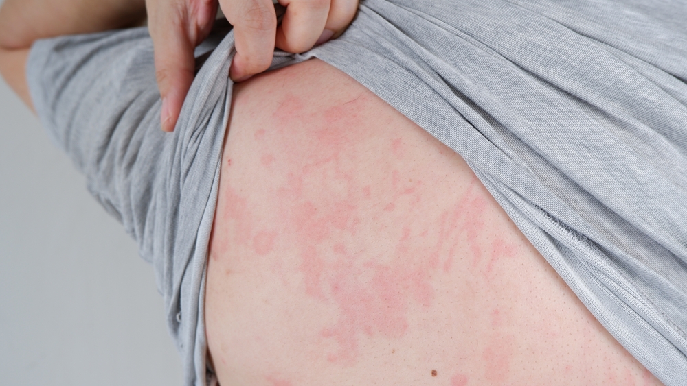 Close up image of skin texture suffering severe urticaria or hives or kaligata on the back. Allergy symptoms.