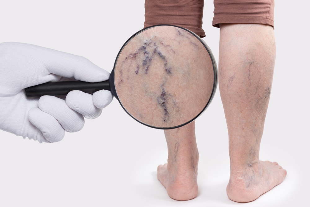 Doctor's hand in a white glove shows zoomed blood vessels with a magnifying glass. Old woman with vascular asterisks on her legs. Rear view. The concept of varicose veins.

