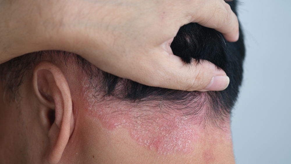 psoriasis on the nape of a man. skin with psoriasis.