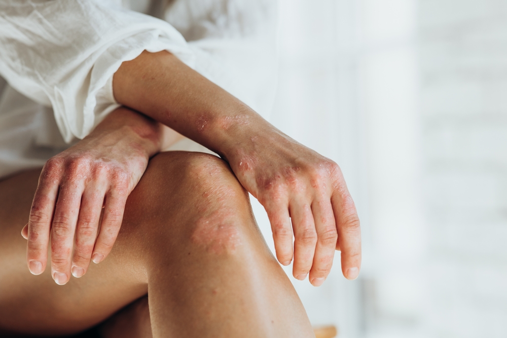 Psoriasis. Acute psoriasis on the knees, body, elbows is an autoimmune, incurable dermatological skin disease. Large, red, inflamed, scaly rash.