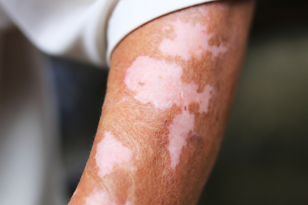 Close-up of old man's hands with vitiligo skin discoloration. a way of life with seasonal skin conditions. Vitiligo, a condition that causes patches on the skin, is a symbol of struggle and effort.
