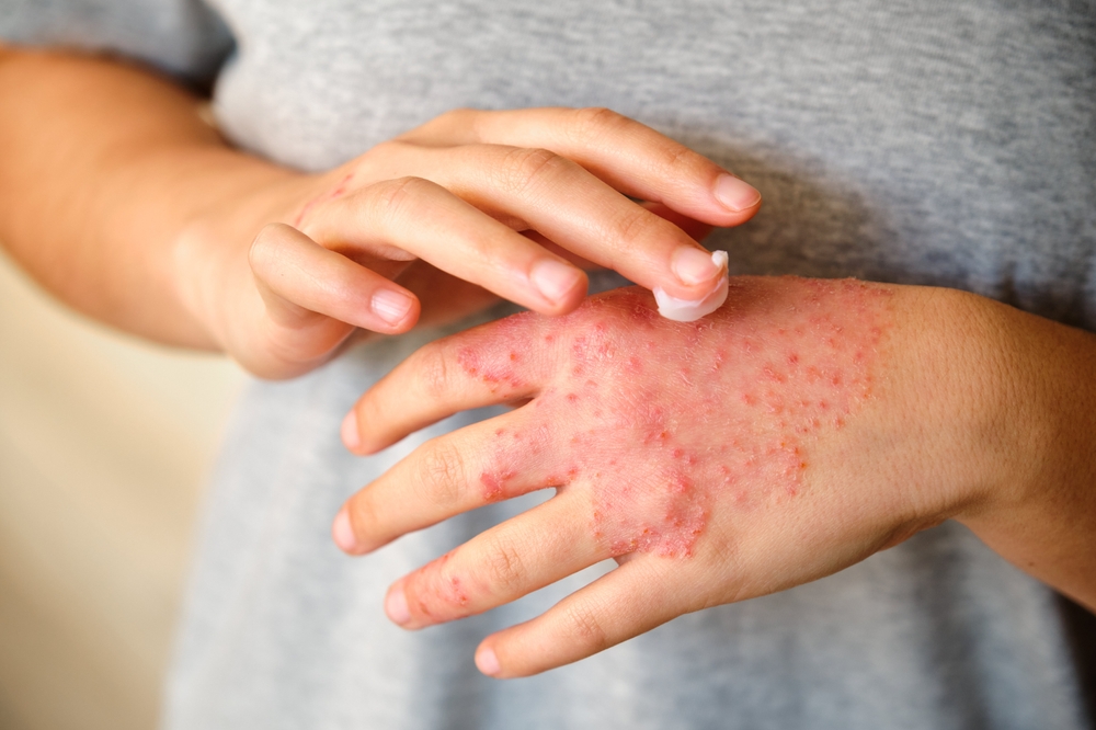 Unrecognizable woman applying ointment or moisturizing cream in the treatment of eczema on hand, atopic dermatitis.

