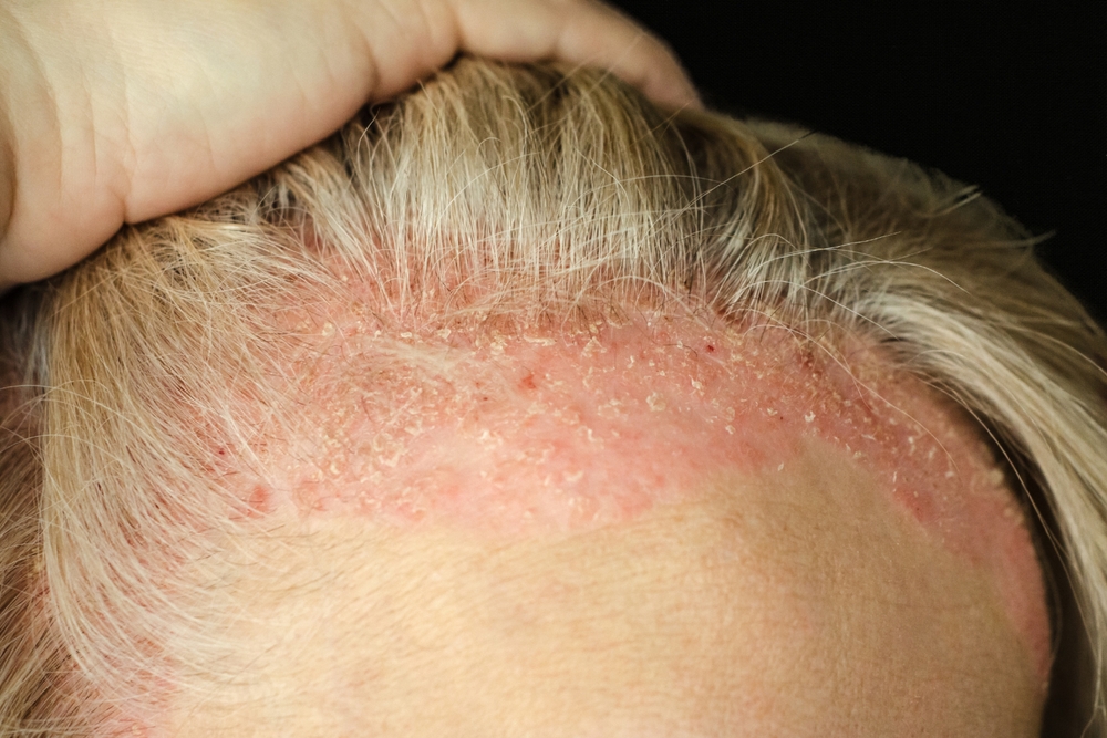 psoriasis.Psoriasis psoriatic skin disease in head hair, skin patches are typicaly red, itchy, and scaly.