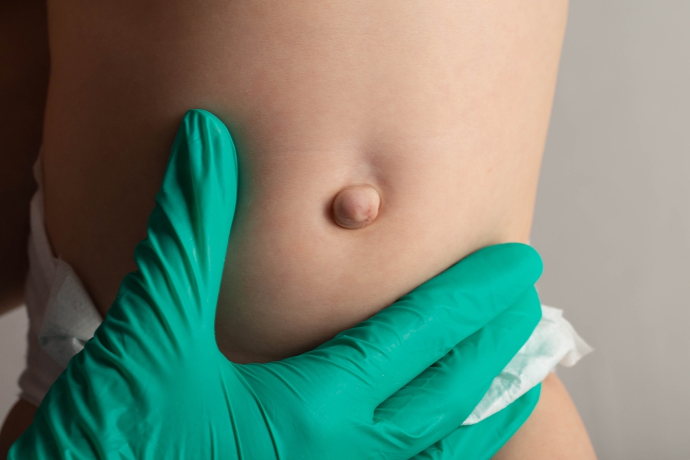 Doctor's hands in green medical gloves examine an umbilical hernia in a child, close-up. Problems