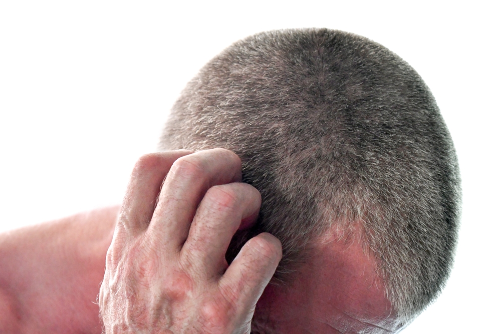 Itchy scalp. Caucasian man itching and scratching his head. Itchiness skin problem. How to fix your dry itchy scalp and healthcare and medical concept.