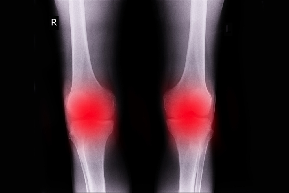 Osteoperosis : OA Knee
