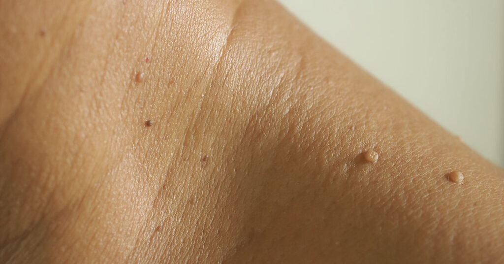 Experts Explain Why Flesh-Colored Moles Appear on the Neck and Armpits - Featured image