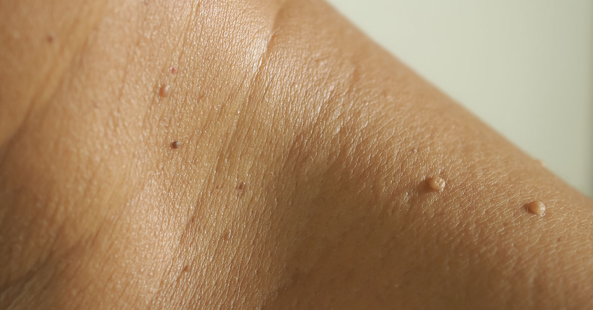 Experts Explain Why Flesh-Colored Moles Appear on the Neck and Armpits