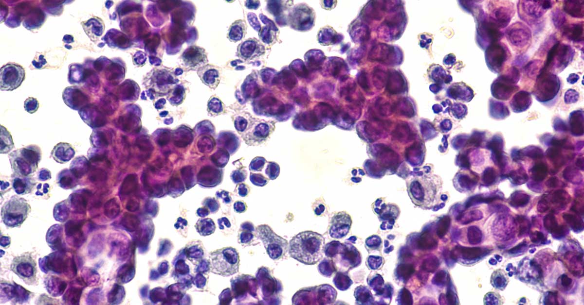 Cancer Cells Self-Destruct – Thanks to This Deep-Sea Sugar