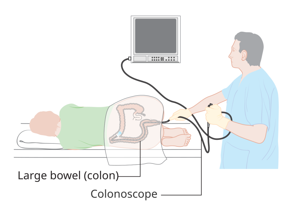 Medical illustration of colonoscopy procedure with patient lying on examination table as healthcare provider performs screening with scope and monitor.