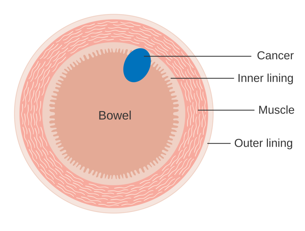 Cross-section diagram of bowel wall showing cancer tumor within the inner lining, muscle, and outer layers of intestinal tissue.