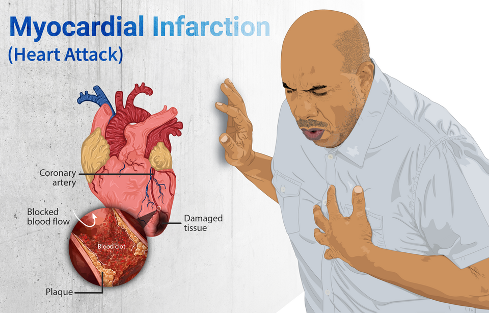 Heart diagram showing blocked coronary artery with blood clot and plaque causing myocardial infarction, with man experiencing chest pain.