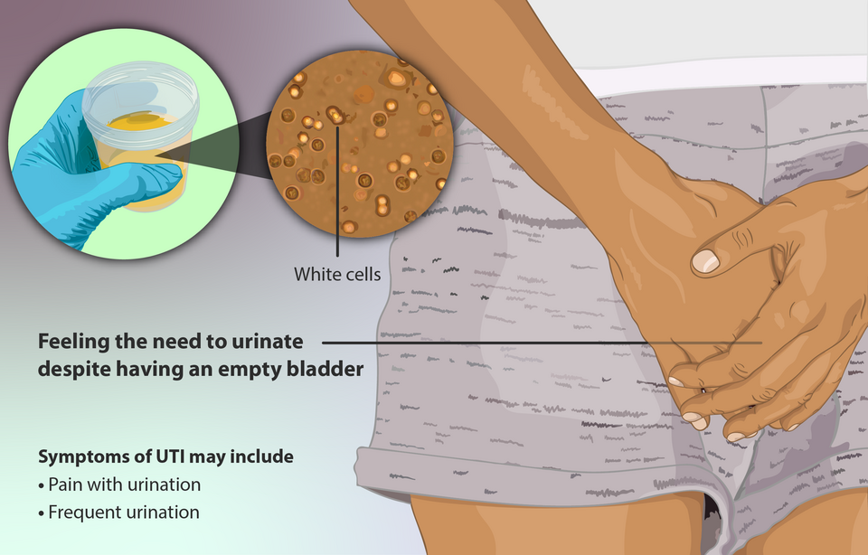 Anatomical illustration showing bladder inflammation and common UTI symptoms including urgency and burning.