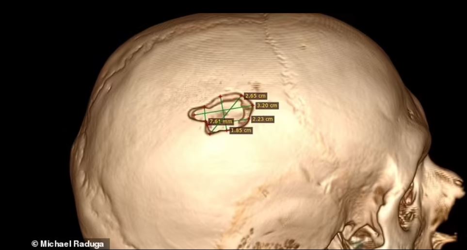 scan showing hole in Michael's head