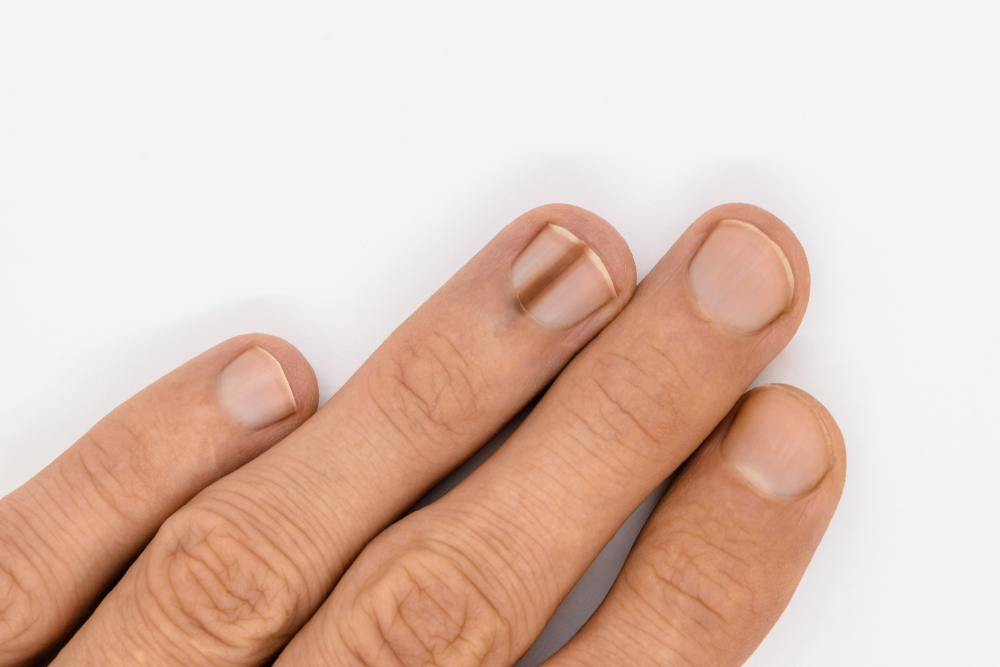 Top view of male hand with brown line on one of the finger's nail better known as melanonychia (nail pigmentation) on white background with copy space