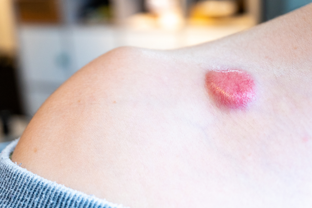 Raised dermatfibrosarcoma protuberans (DFSP, non-melanoma skin cancer) on chest shoulder having formed red pigment and spider veins, removable by mohs surgery