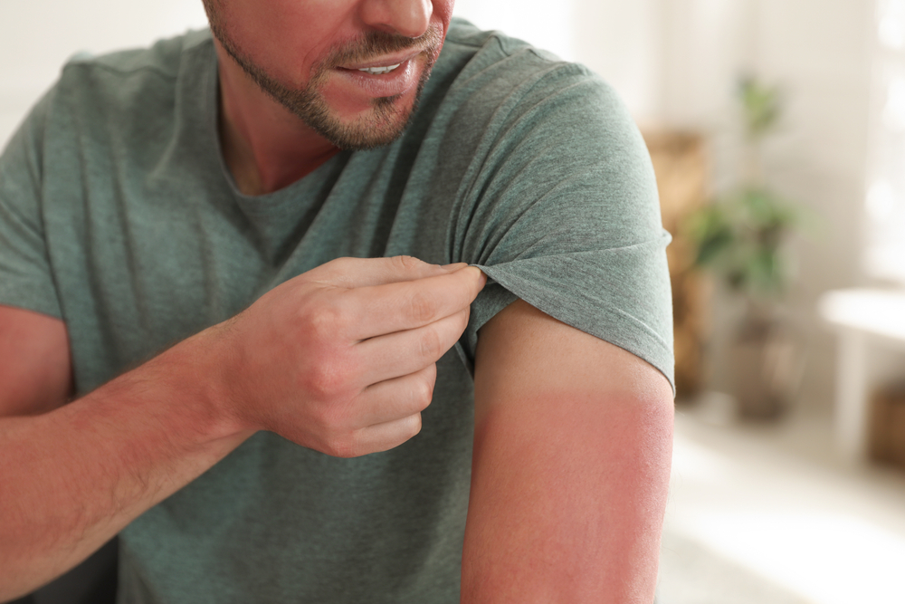 Man with sunburned skin at home, closeup