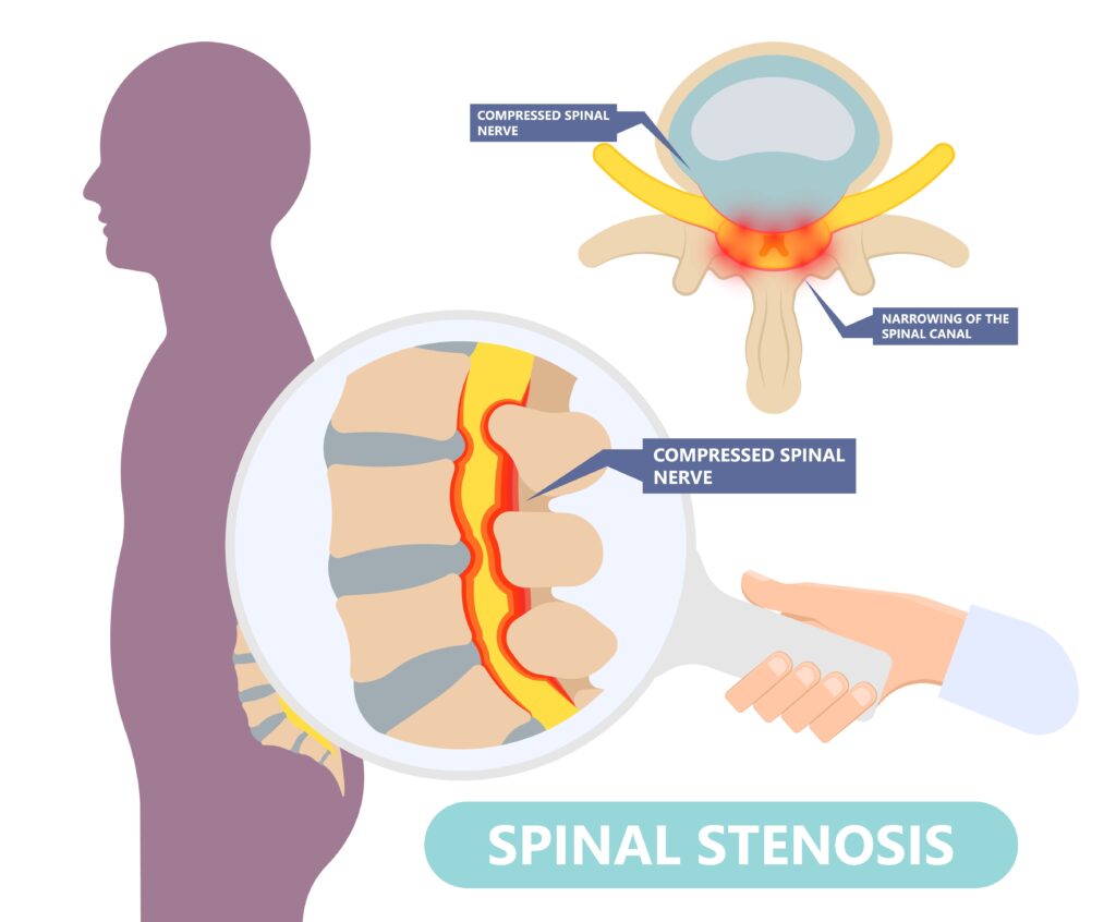 Spinal stenosis a narrowing of the spaces of the spine that causes lower back pain