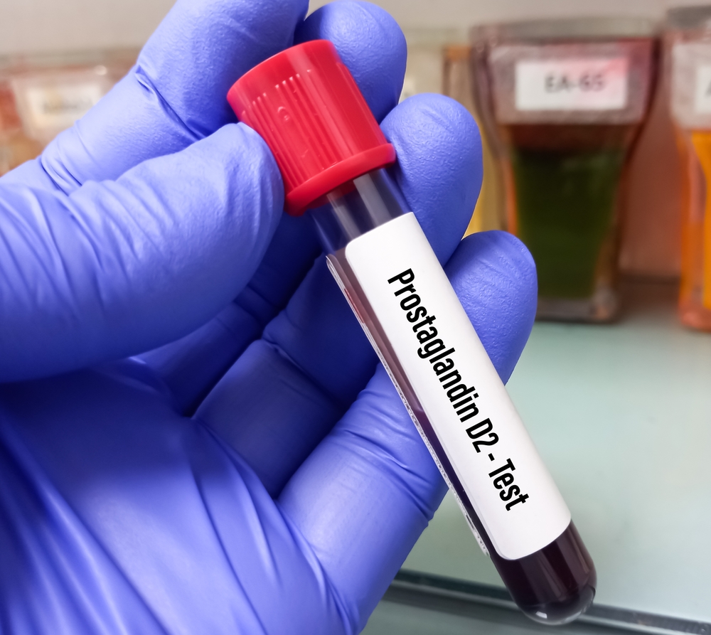 Blood sample for Prostaglandin D2(PG D2) test, Prostaglandin synthesis including PGD2 are Vitamin K and Vitamin D3. Close view.