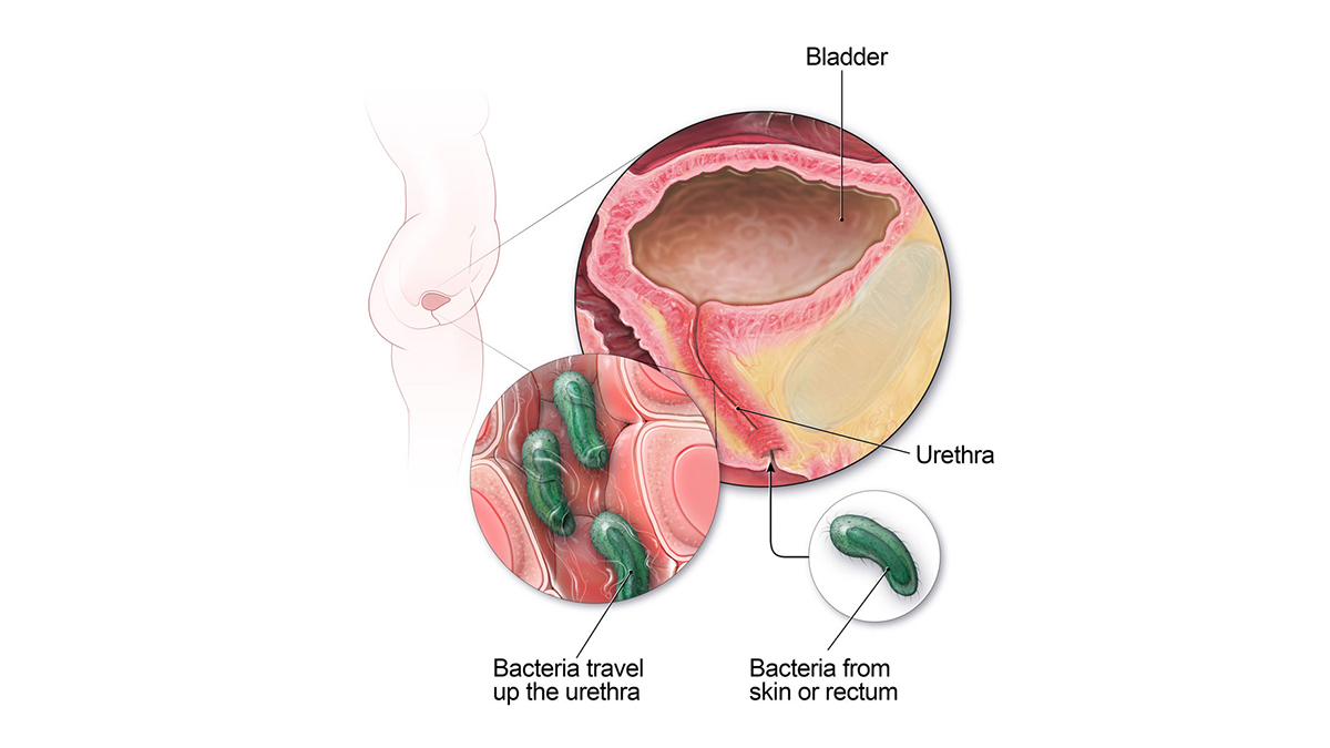 Cross-section diagram highlighting the short female urethra that increases infection risk.