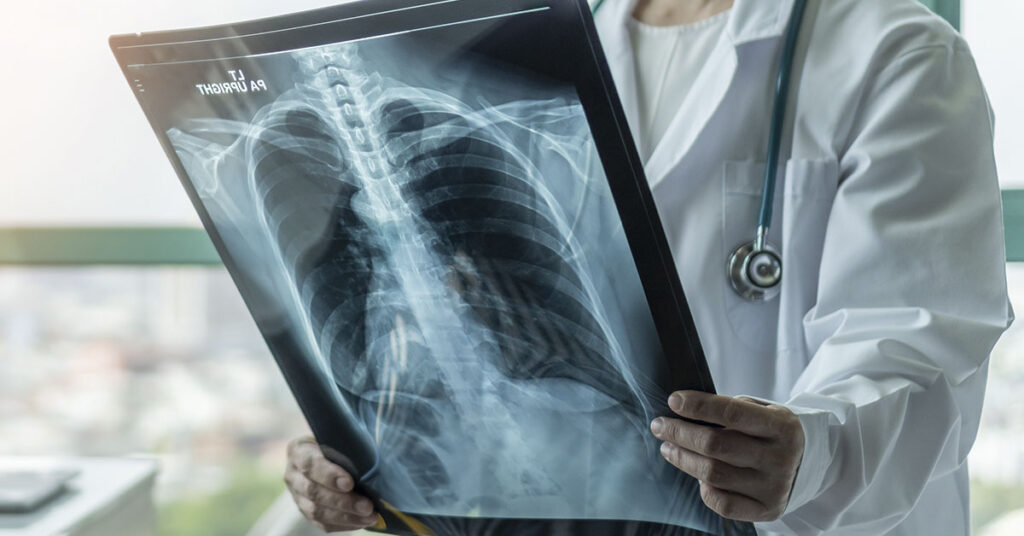 He Never Smoked, But Still Got Lung Cancer at 45. Here’s the One Symptom He Noticed - Featured image