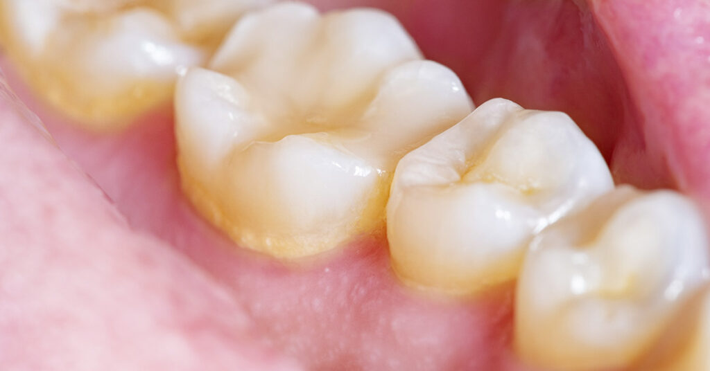 5 Home Remedies for Removing and Preventing Dental Plaque - Featured image
