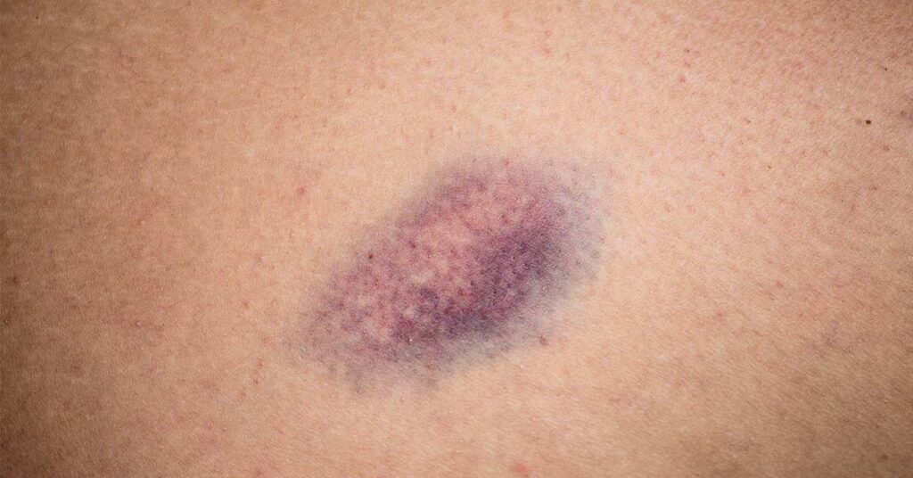Why So Many Women Wake Up With Bruises They Don’t Remember Getting - Featured image