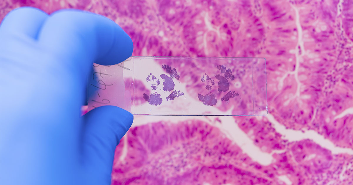 Millennials Face Surge in Rare Cancer as Experts Warn of ‘Tip of the Iceberg’